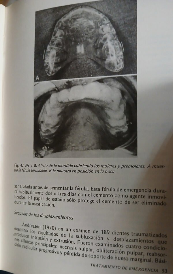 Tratamiento De Dientes Traumatizados En Niños - Hargreaves