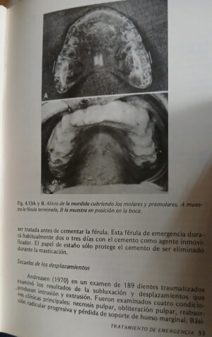 903934-MLA91215510083_082025 Tratamiento De Dientes Traumatizados En Niños - Hargreaves